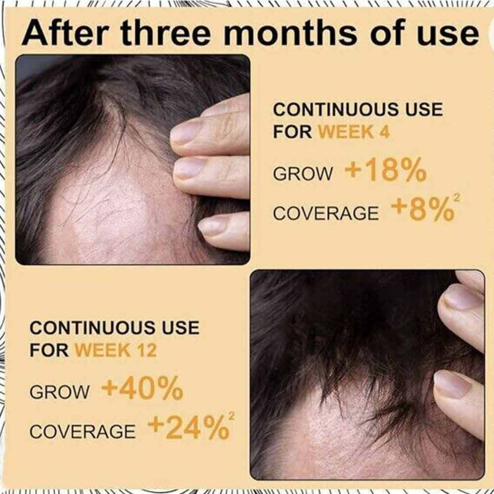 Hair Growth Moussmi Hair Growth Moisturizing Scalp anti Loss Hair Care 60Ml 2024